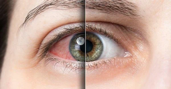 Lutein Help Dry Eyes